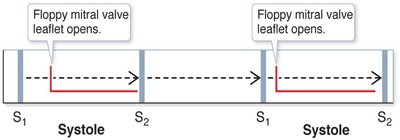 Mitral valve prolapse murmur timing diagram