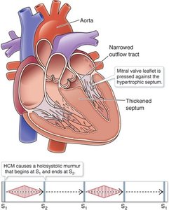 Hypertrophic cardiomyopathy diagram