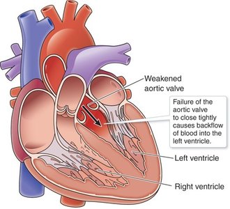 Aortic insufficiency diagram