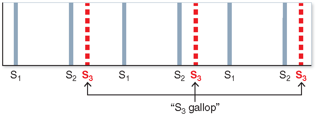 S3 gallop timing diagram
