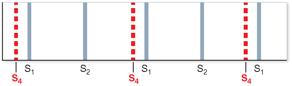 S4 heart sound timing diagram