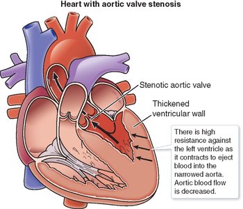 Heart with aortic valve stenosis