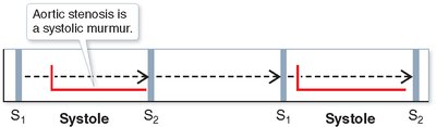 Aortic stenosis murmur timing diagram