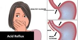 Diagram showing acid reflux (GERD)