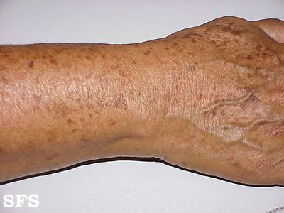 Lentigines: Age spots on the skin