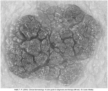 Seborrheic keratosis: brown, raised lesion