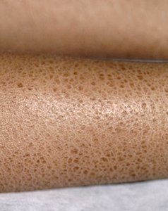 Dry skin (xerosis) close-up