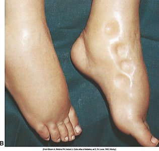 Pitting edema in the foot