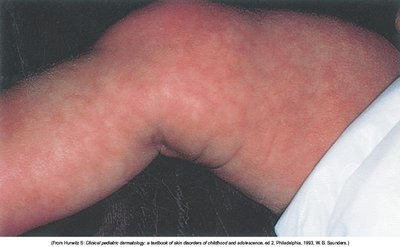 Cutis marmorata in an infant