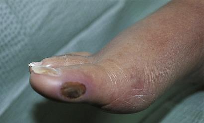 Diabetic foot ulcer