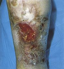 Venous stasis ulcer