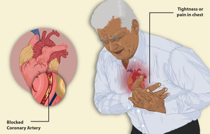 Chest pain and angina