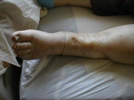 Edema in heart failure