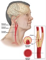 Carotid artery assessment