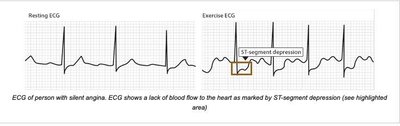 ECG showing silent angina with ST-segment depression
