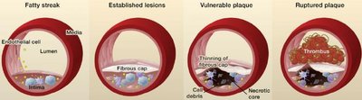 Progression from fatty streak to ruptured plaque in atherosclerosis