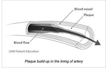 Plaque build-up in the lining of an artery