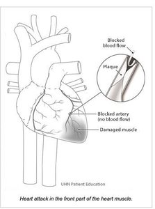 Diagram showing a heart attack due to blocked artery and damaged muscle