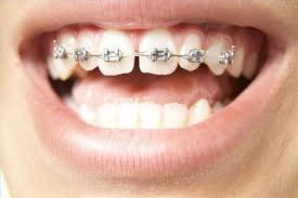 Teeth with braces