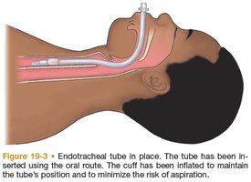 Endotracheal tube in place