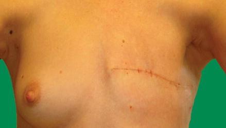 Mastectomy site
