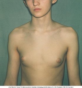 Breast development in infants and children