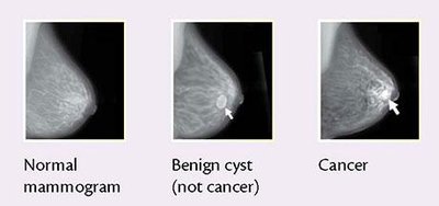 Mammogram comparison: normal, benign cyst, cancer
