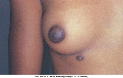 Supernumerary nipple