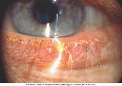 Normal conjunctiva and sclera