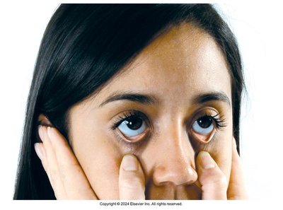 Palpation of lacrimal sac