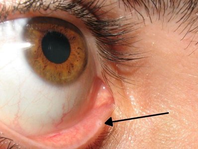 Eversion of upper eyelid