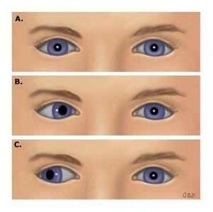 Corneal light reflex test