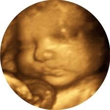 Ultrasound image of fetus