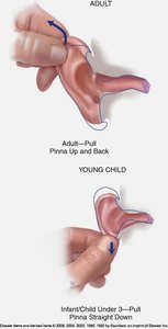 Technique for pulling the pinna in adults and children during otoscope exam