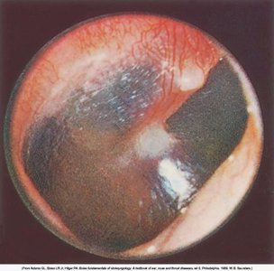 Otoscopic image of otitis media (red, inflamed tympanic membrane)