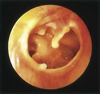 Otoscopic image of ruptured tympanic membrane