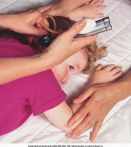 Child with T-tube in tympanic membrane