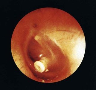 Aging ear with pendulous earlobe