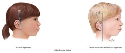 Comparison of normal and low-set ear alignment in children