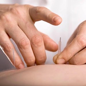 Acupuncture needles being applied to a patient