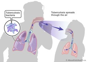 Tuberculosis airborne transmission