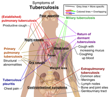 Symptoms and complications of tuberculosis