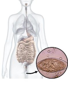 Schistosomiasis egg in human host