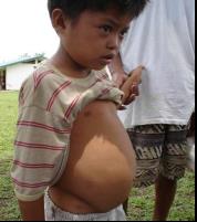 Child with ascites from schistosomiasis