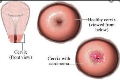 Healthy cervix and cervix with carcinoma