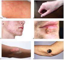 Images of common skin disorders including acne, herpes, and melanoma
