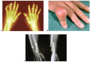 Images of skeletal disorders including arthritis, gout, and fractures