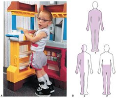 Image showing effects of nervous system disorders