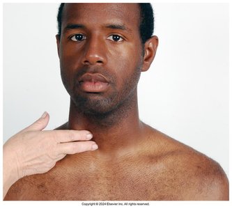 Palpation of the carotid artery