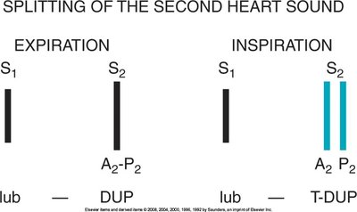 Splitting of the second heart sound